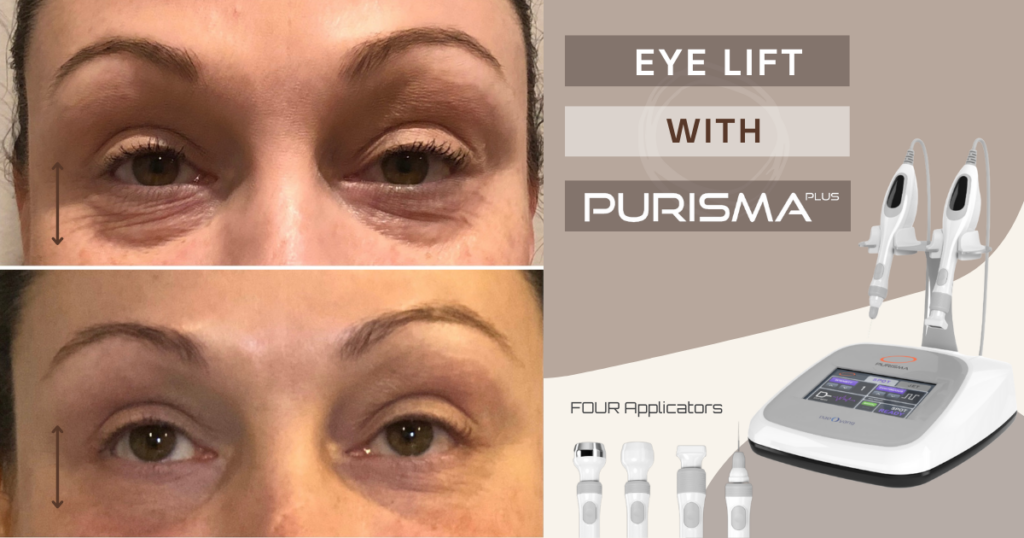 Eye Lift With Purisma