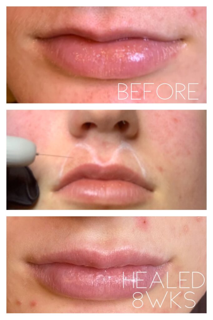 Plasma Skin Tightening Before and After around lips