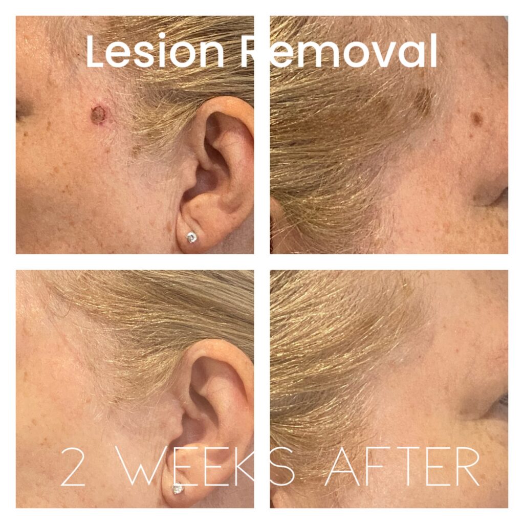 Plasma Skin Tightening Lesion removal before and after