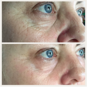 Plasma Skin Tightening Before & After