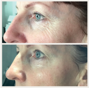 Plasma Skin Tightening Before & After