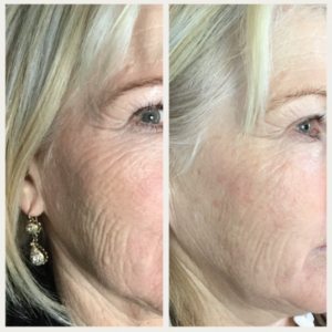 Plasma Skin Tightening Before & After