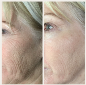 Plasma Skin Tightening Before & After