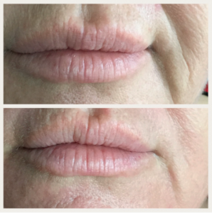 Plasma Skin Tightening Before & After